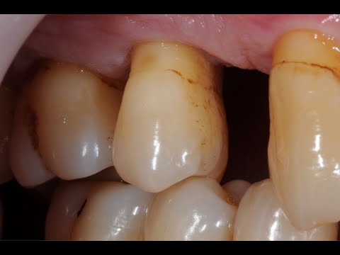 Tooth preparation: Malposed teeth