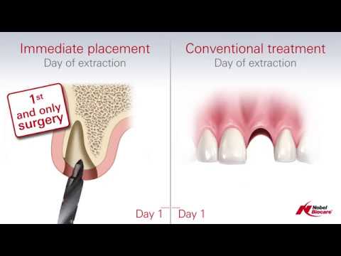 Immediate Placement vs Conventional Treatment (Dental Implants)