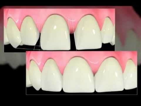 Veneers and Orthodontics Combined