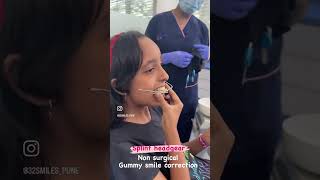 #Splint headgear for gummy smile correction  in growing patients #32smilespune