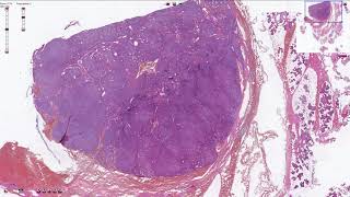Basal Cell Adenoma -  Salivary Gland Histopathology