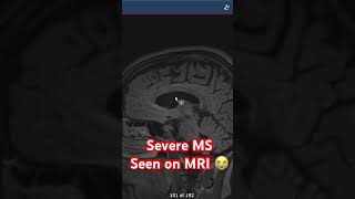Severe MS seen on MRI 😭
