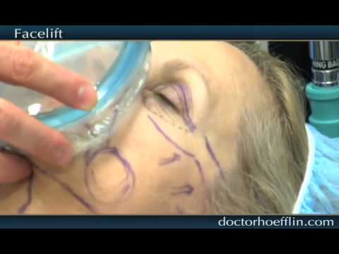 Facelift Surgery Los Angeles - Dr. Hoefflin