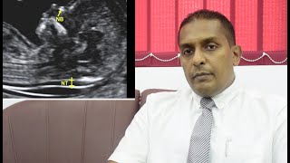 Nuchal Translucency Scan (NT Scan) Prof. Tiran Dias