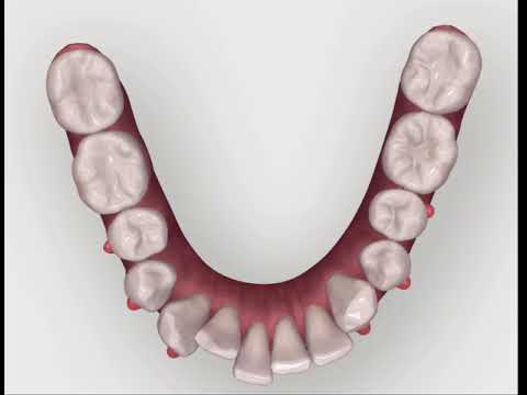 Invisalign Tooth Movement - JB White DDS Las Vegas
