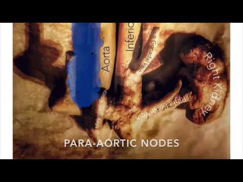 RPLND for prostate cancer -  narrated