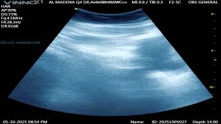  GYN : PT +VE  ,BLEEDING , NO SAC  2025 10 05 20 49 