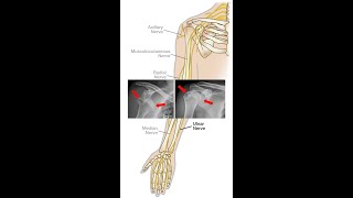 Nerves of the Arm