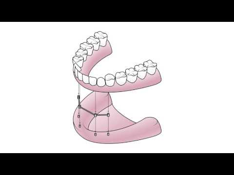 FAQ - What is an All-On-4 Dental Implant? | 21st Century Dental