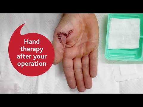 Hand Therapy After Your Operation