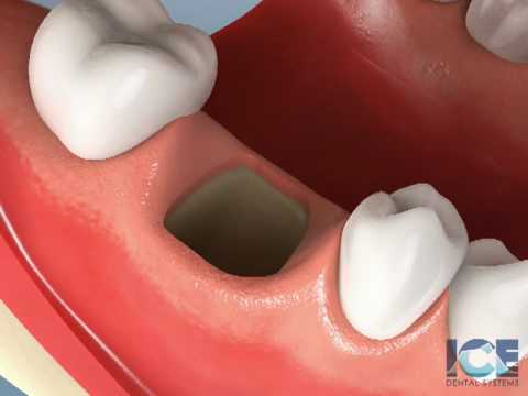 Socket Preservation