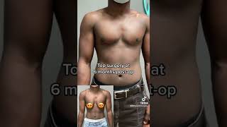 Top surgery at 6 months post-op #ftm #pridemonth #topsurgery