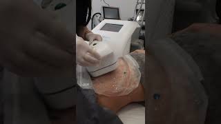 Cooltech Soğuk Lipoliz | Zen Poliklinik #ataşehir #cooltech #soğuklipoliz #bölgeselincelme