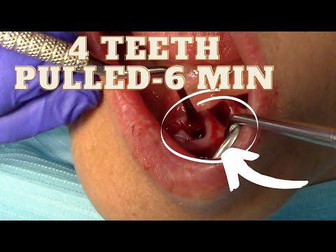 NEGLECT -4 Teeth Extracted due to Disease (Extracted Under 6 Minutes?!)