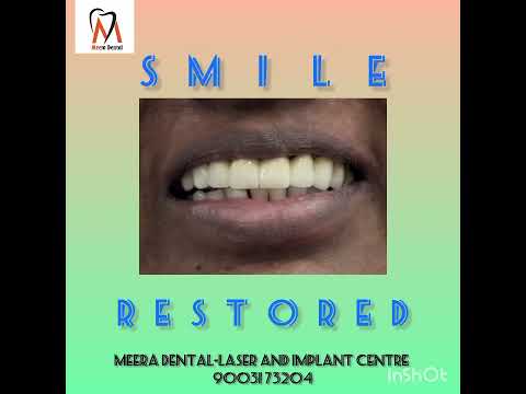 FORWARDLY PLACED FRONT TOOTH CORRECTION -WITH SMILE MAKEOVER-TRANSFORMATION#HEALTHY TEETH