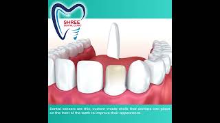 Dental Knowledgedental veneers   #dentalcare #dentistry