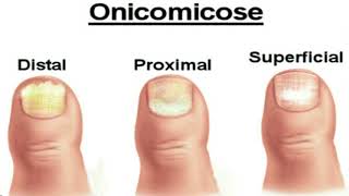 Onicomicose / Micose nas unhas: saiba tudo! (Dra Gisele Dermatologista - Médica pela USP)