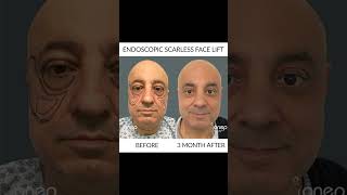 Scarless Face Lift 💫
