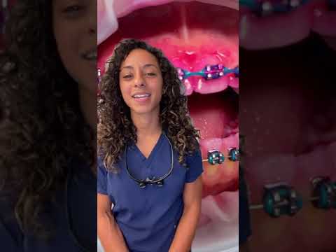 #disclosingtime during #braces #Shorts