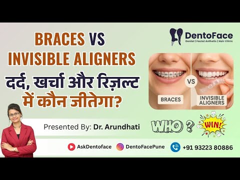 Braces vs Invisible Aligners – दर्द, खर्चा और रिज़ल्ट में कौन जीतेगा? ‎⁨ - Dr.Arundhati
