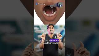 மலோ பிரிட்ஜ் என்றால் என்ன? - What is malo bridge? | Dr.karthikeyan | Denta Kings