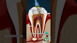 🦷 Root canal Treatment#rootcanalspecialist #teeth #dental #ytshorts #youtubeshorts #viral #trending