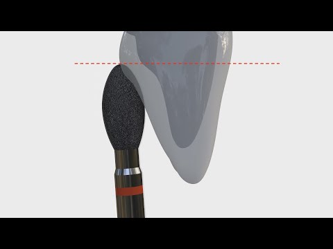 Tooth preparation: Palatal surface