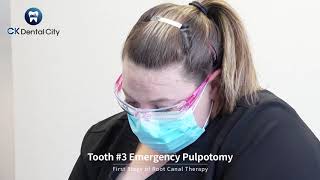 [CK Dental City] Tooth #3 Emergency Pulpotomy Frist Stage of Root Canal Therapy
