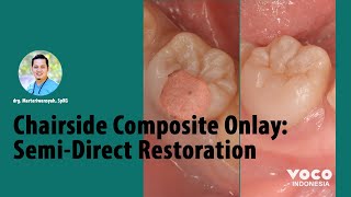 Chairside Resin Composite Onlay: Semi-Direct Restoration ǀ Die Silicone (VOCO GmbH)