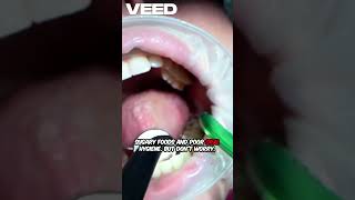 Prevent Dental Caries Now #dentalcaretips #dentalhygiene