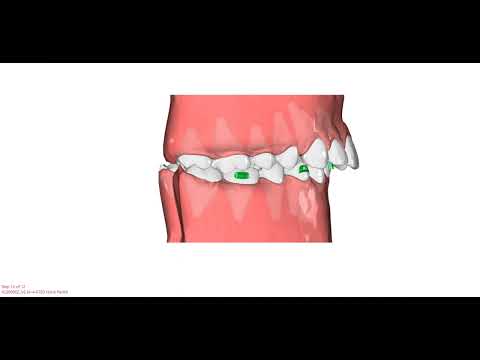Aligner Virtual tour