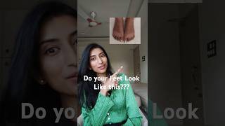 Dark and Patchy Feet? Solution!! #feet #footcare #footcaretips #pigmentation #pigmentationsolution