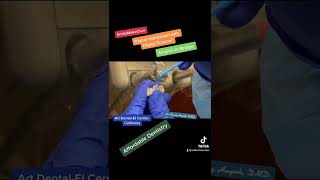 Digital Impression Digital Scanner Digital Zirconium Bridge