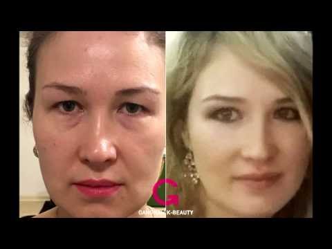 Dr. Jung, Medical staff of Gangnam K-Beauty. Plastic Surgery case with Julia