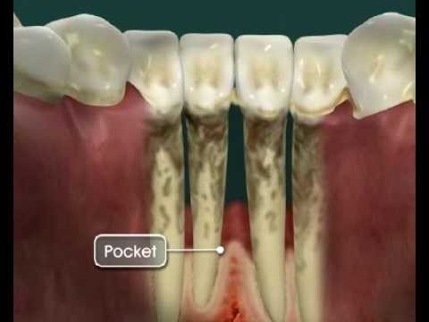 Periodontal