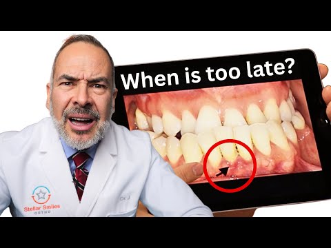 83% of Parents Miss the Right Age for Braces