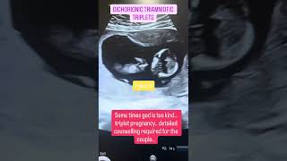Dichorionic triamniotic triplets on scan at NT scan #triplets #tripletscan #pregnancyscan #ntscan