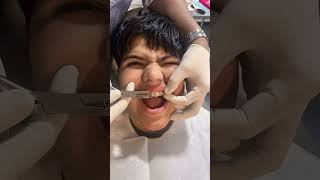 Dental Braces (Dental Clip) for kids in Chennai #dentistinchennai