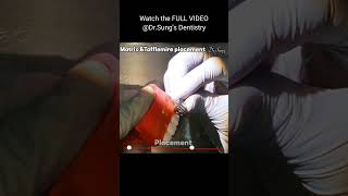 Matrix band, Tofflemire, wedge placement tips
