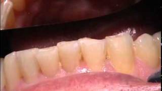 Techniques to Create Beautifully Esthetic Direct Composite Restorations by Dr. Michael Koczarski