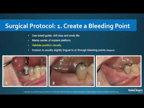 Guided Surgery Solutions ThinLayer Orientation and Overview