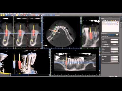 GSS Webinar - Case AD #29,30 - Articulated Model