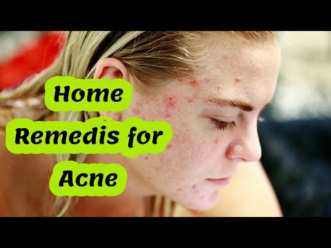 How to Get Rid of Acne at Home Naturally