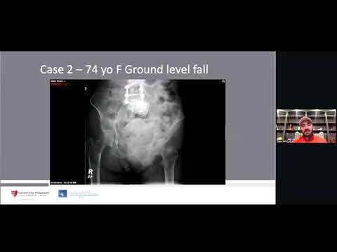 LC2 Fixation along with Intersecting Fixation Pathways