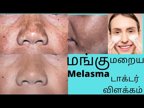 How to cure darkspots on face melasma removal/ Home remedies/ Tamil
