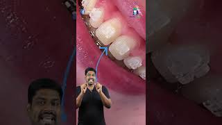 கிளிபுக்கு பிறகும் இடைவெளி இருக்குமா? - Incisal embrasure | Dr.Karthikeyan | Denta Kings