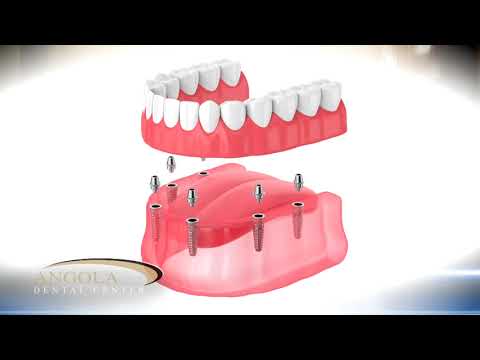 Angola Dental Center - Implants Supported Dentures