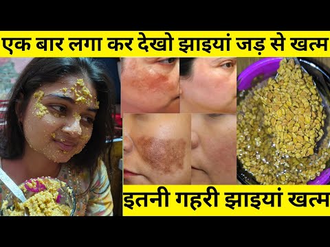 झाइयां खत्म करने का देसी नुस्खा सब हैरान  super fast pigment remove 100%