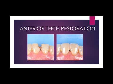 Anterior teeth restoration ♠️