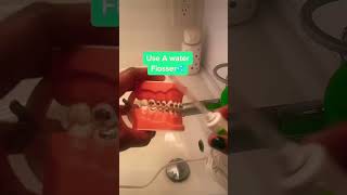 How to avoid white spots with braces #braces #dentaltips #shorts30